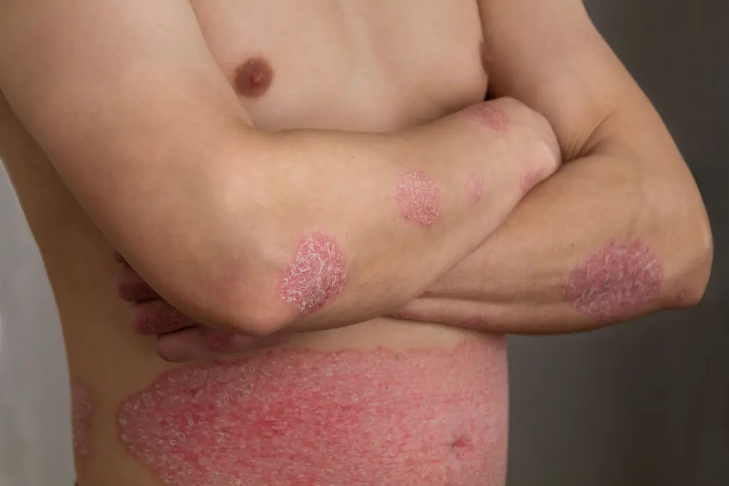 Preparaty na łuszczycę z polecenia dermatologów
